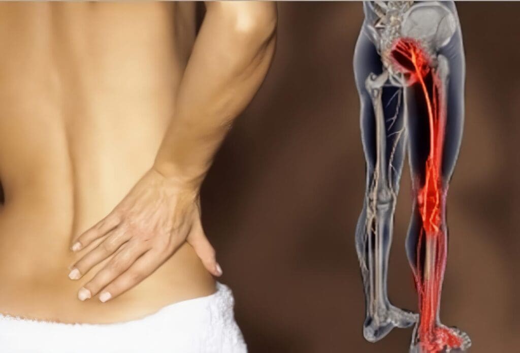 Ciática: Síntomas, Tratamiento, Causas y Complicaciones