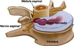 Hernia de los discos intervertebrales