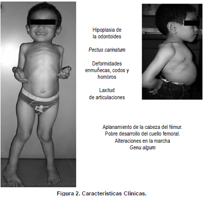 Fenotipo clásico de mucopolisacaridosis IV A