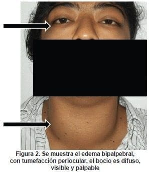 Edema Bipalpebral