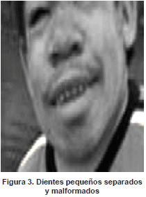 Dientes pequeños separados y malformados