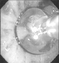 Catéter de endoscopia intrabronquial