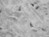 Biopsia de endometrio que muestra un bacilo ácido alcohol resistente