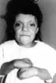 Paciente femenina de 6 años de edad, con sindrome de Apert.