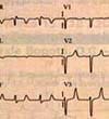 Electrocardiograma, hipercalemia e hipocalcemia.