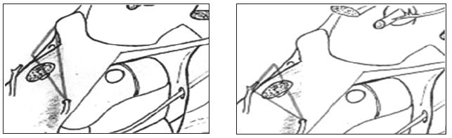 Triangulo ínfero medial