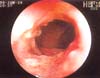 Compromiso del ciego y de la válvula íleocecal, Histoplasmosis Intestinal