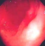 Carcinoma gástrico temprano antral