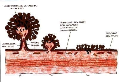 Localización de los pólipos