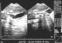 Ecografía hepática que muestra imágenes sugestivas de cálculos vesiculares (derecha) y una imagen típica de un áscaris (izquierda).