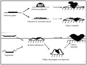 Colon: Adenomas Planos Colorrectales Correlación Endoscópica e Histológica