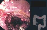Hematoma submucoso 