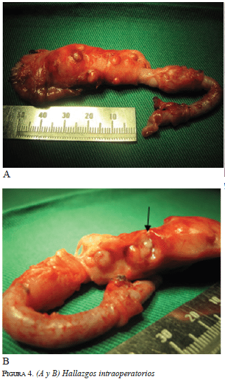 Hallazgos Intraoperatorios
