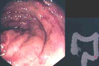 Mucosa pálida, membranas grisácesas