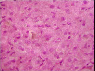 Colestasis intrahepática Colestasis intrahepática