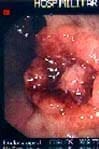 Colonoscopia de un tumor