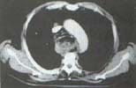 Hematoma esofágico (a)