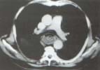 Hematoma esofágico (b)