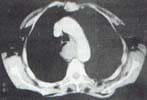 TAC helicoidal-1