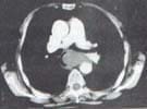 TAC helicoidal-2
