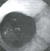 Esofagitis grado II