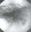 Esofagitis grado III