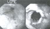 Esofagitis grado IV complicada con estenosis