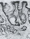 Epitelio de Barret
