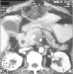TAC abdominal que muestra drenaje TAC abdominal que muestra drenaje