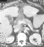 TAC abdominal que muestra fístula