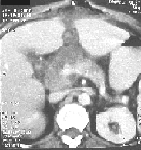 TAC abdominal donde se evidencia un absceso de cabeza de páncreas