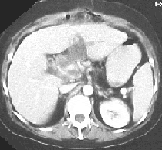 TAC abdominal que muestra absceso de cabeza de páncreas