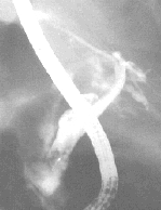 Fístula del absceso pancreático vía biliar