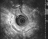 Tumor endocrino pancreático en el cuerpo, insulinoma.