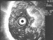 Imagen endosonográfíca de un tumor t2 gástrico, ulcerado.
