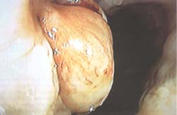 Melanoma Amelanótico