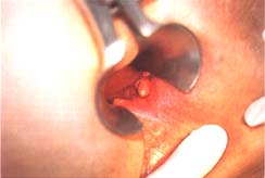 Melanoma amelanótico del canal anal, Melanoma Anal