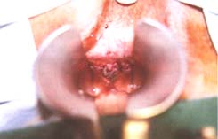 Melanoma del canal anal en mujer de 61 años