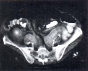 Engrosamiento de la Pared Intestinal