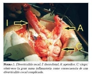 Diverticulitis cecal