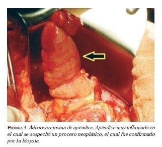 Adenocarcinoma de apendice