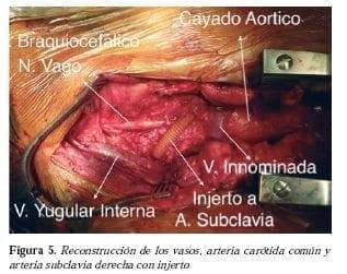Reconstrucción de vasos y arterias con injerto