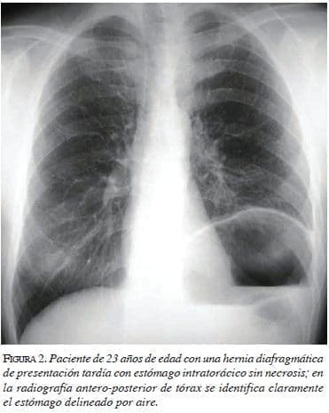 figura2-hernia-diafragmatica 