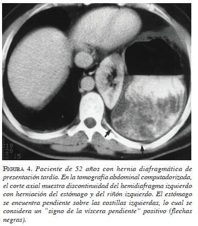 figura4-hernia-diafragmatica