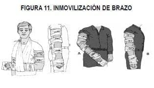 Inmovilización de brazo Inmovilización de brazo