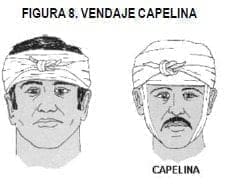 Vendaje capelina Vendaje capelina