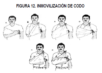 Inmovilización de Codo y Antebrazo Inmovilización de Codo y Antebrazo
