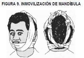 Inmovilización de Mandíbula Inmovilización de Mandíbula