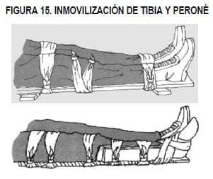 Inmovilización de tibia y peroné Inmovilización de tibia y peroné