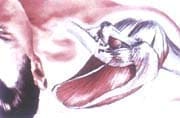 Reducción anatómica de la articulación acromioclavicular Reducción anatómica de la articulación acromioclavicular